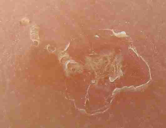 cunicolo scabbia